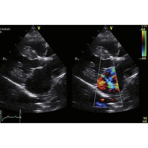 ultrasound image courtesy Dr. Miller; Canine heart: A two-dimensional ultrasound “greyscale” image (left) reveals a thickened mitral valve that prolapses and leaks. On the right, the same image is overlaid with Doppler flow color; the green portions indicate disturbed turbulent flow across the leaky valve. PHM1214 PF VN3