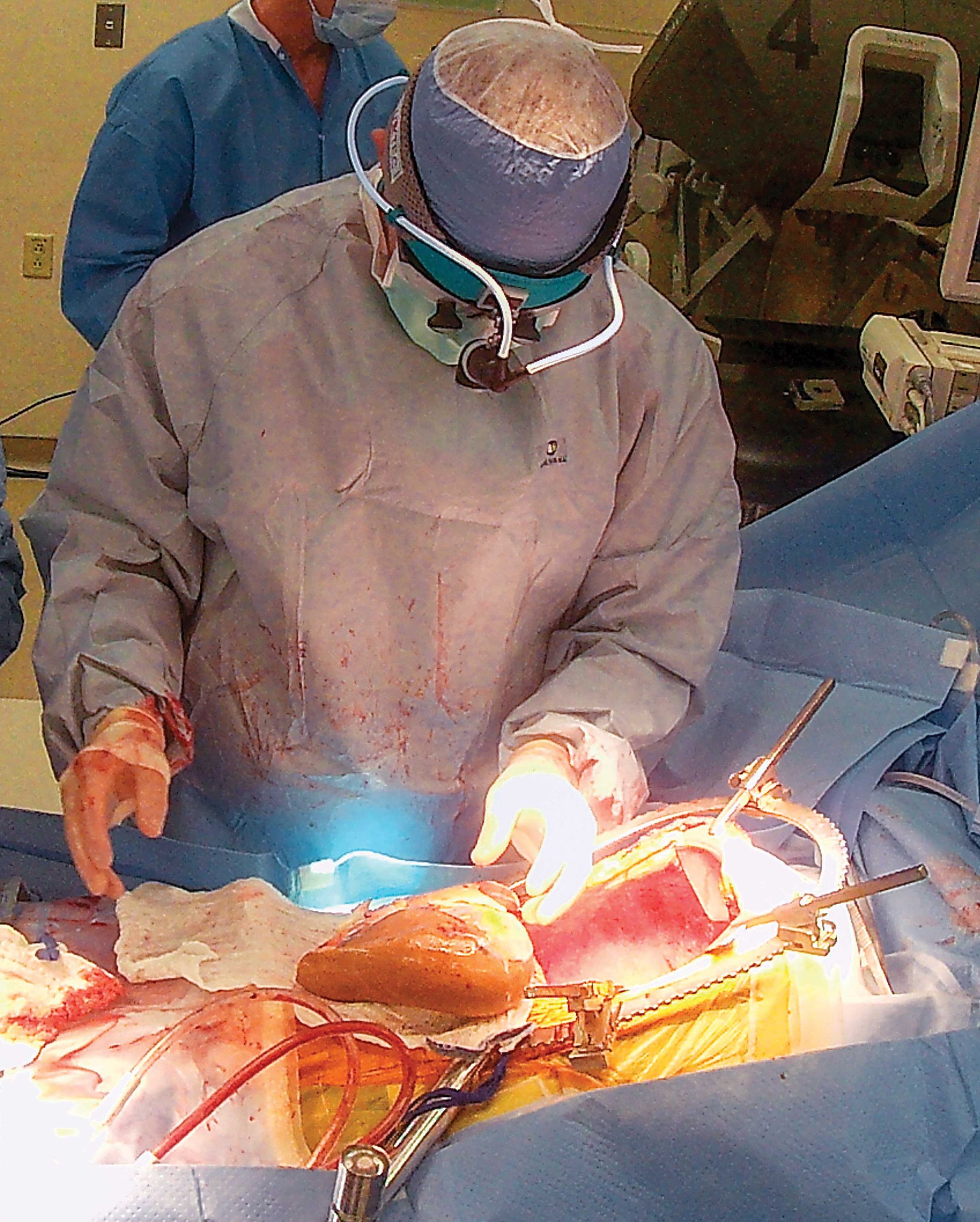 Phoenix surgeon Dr. Jeffrey Brink has performed hundreds of liver and kidney transplants. Phoenix surgeon Dr. Jeffrey Brink has performed hundreds of liver and kidney transplants.